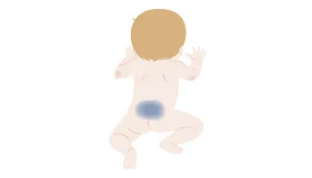一般的な蒙古斑